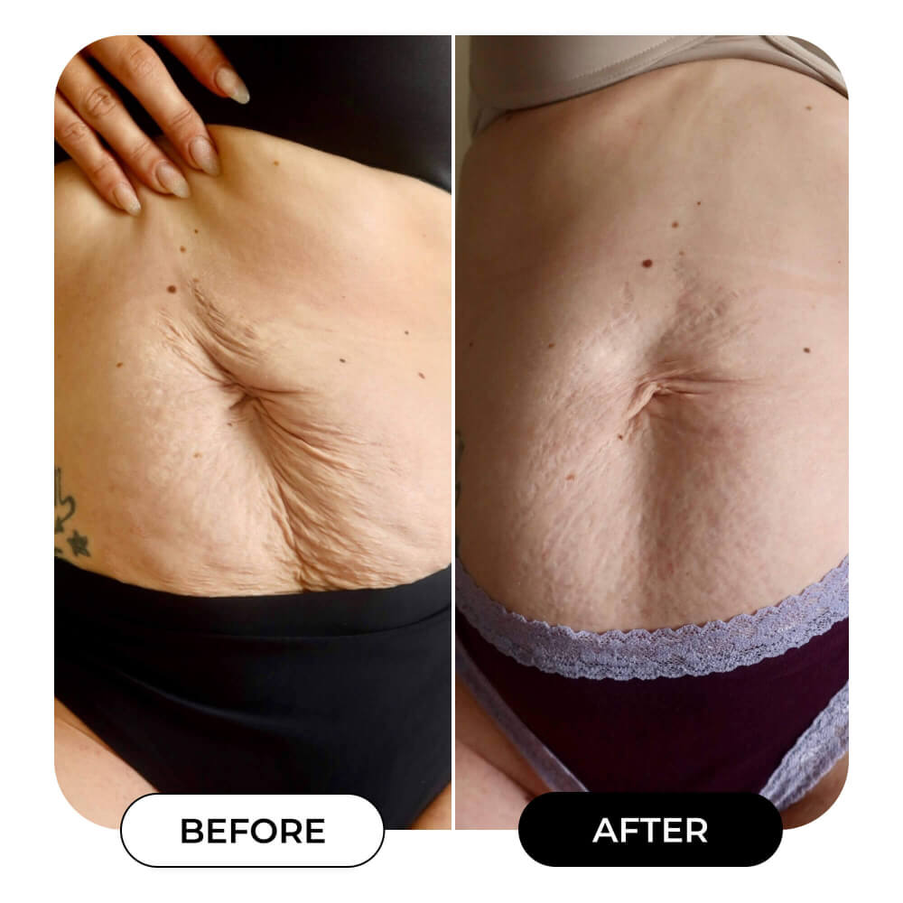 Final 3 hours-60%OFF🔥The Skin-Smoothing Duo Tightens, Firms, And Smooths The Look Of The Skin.