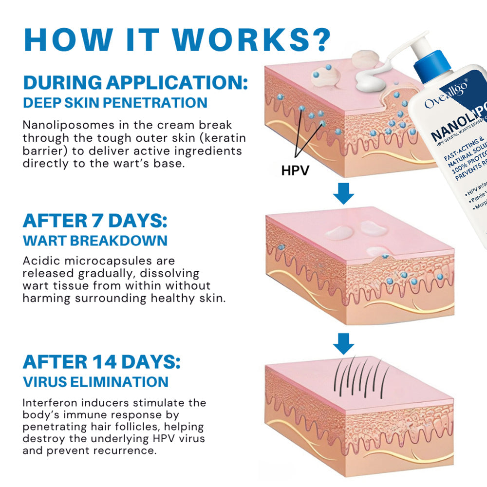 Qvedfo® NanoLipo HPV Genital Warts Eraser Cream Prox