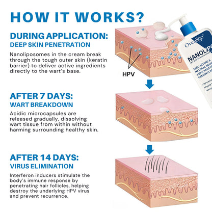 Qvedfo® NanoLipo HPV Genital Warts Eraser Cream Prox